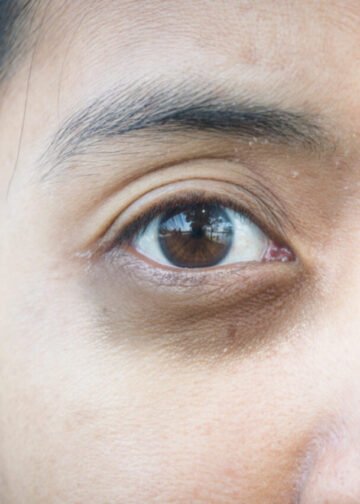 dark circles