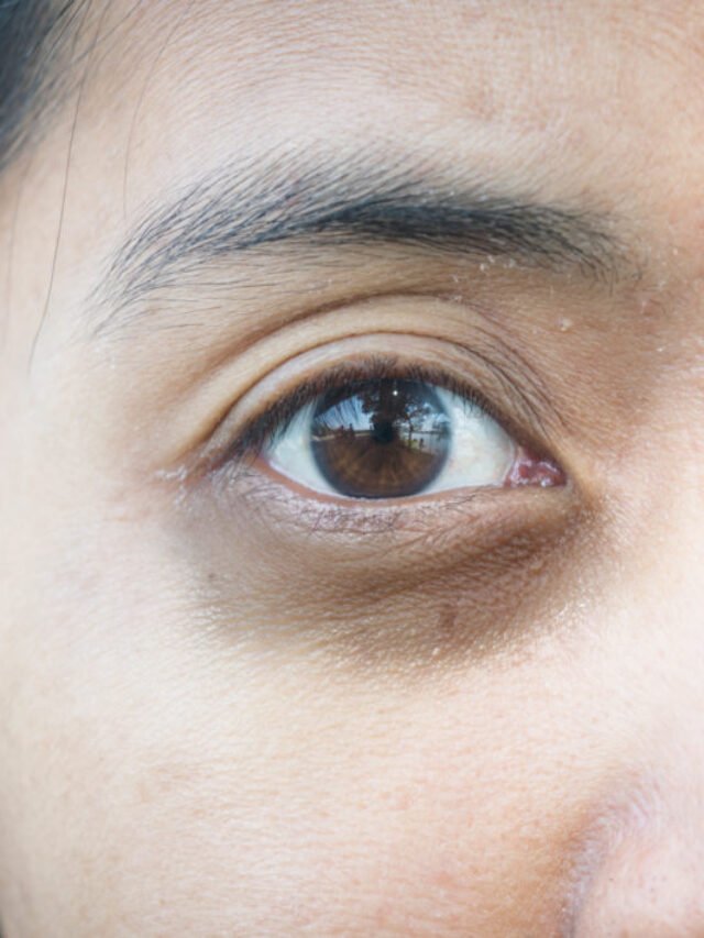 डार्क सर्कल हटाने के लिए ये 7 आसान होम रेमेडीज़