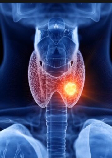 Thyroid Cancer